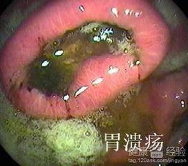 胃溃疡吃角瓜,天然食疗的养胃之道